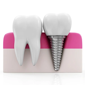 Teeth Implants or Dentures
