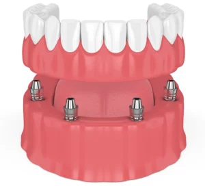 Denture Stabilization