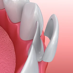 Do Veneers Break Easily