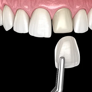 What Are Dental Veneers