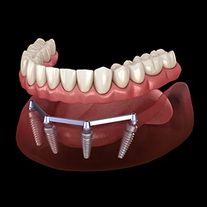 What Are All-on-4 Dental Implants?