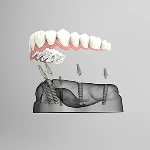 What Are All-on-4 Dental Implants
